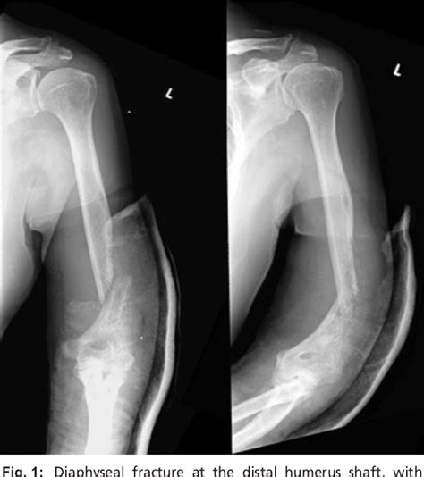 Figure 1 From A Rare Case Of A Distal Humerus Pathological Fracture