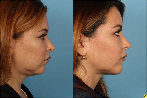 Before And After Pictures Chin And Submental Liposuction Chicago Ildr Sidle