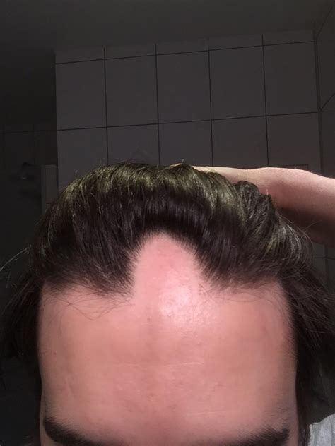 Has Anyone Ever Seen A Hairline Like This This Is My Natural Hairline