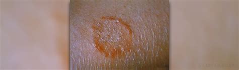 Here you may to know how to bleach ringworm. Bleach on ringworm | General center | SteadyHealth.com