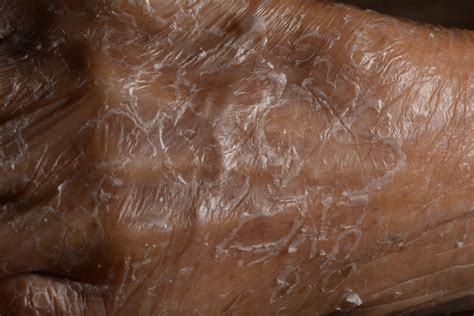 Scaly Dry Skin Learn About Ichthyosis Facty Health