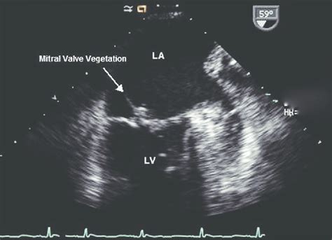 Transesophageal Echocardiogram Mitral Valve Vegetation Download