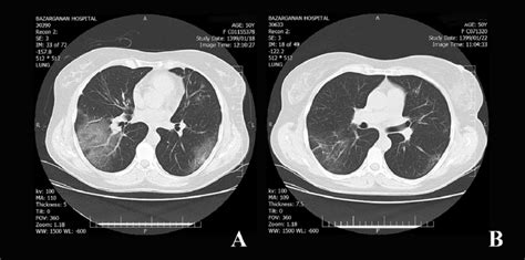 Spiral Lung Ct Scan Of A 50 Years Old Patient With Covid19 A Apr 6