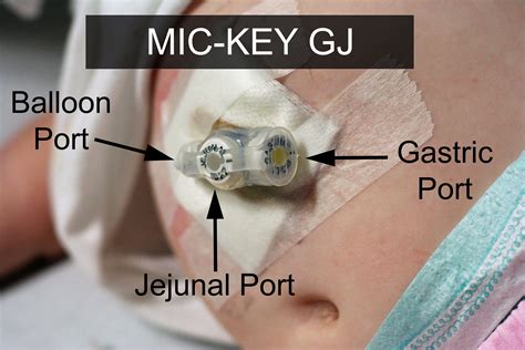 A Gastro Jejunal Or Gj Tube Can Be A Great Aid For Individuals With Dysmotility Those Who