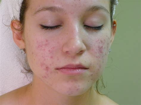 Facial Acne Dorothee Padraig South West Skin Health Care