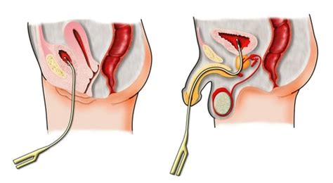 Urethral Catheterization With Foley Catheter In New York City