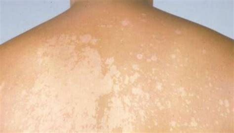 Eczema White Patches On Skin Treatment