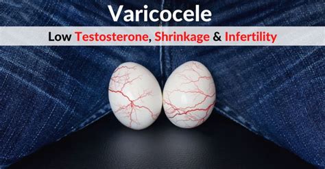 Varicocele Scrotum Varicose Veins Low Testosterone Testicular