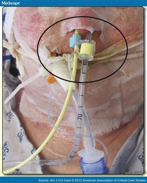 Nasal Bridling To Secure Enteral Tubes In Burn Patients
