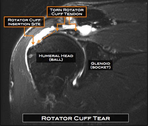 Rotator Cuff Tear Mri Images