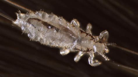 Video Secrets Of Head Lice And How To Beat Them Shots Health News Npr