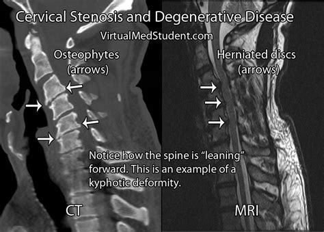 Cervical Myelopathy And Stenosis