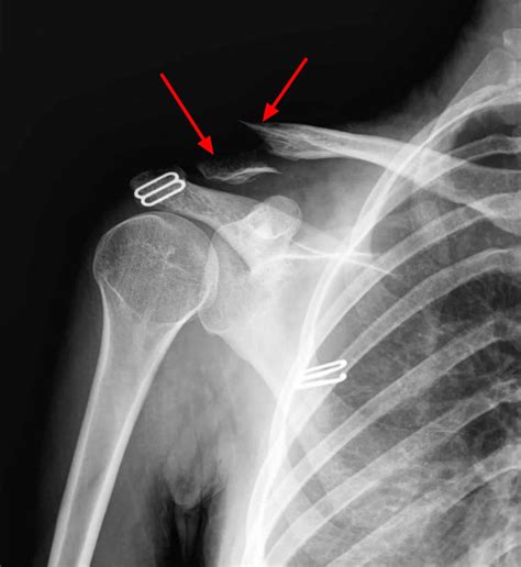 The Fascinating Clavicle And Scapula