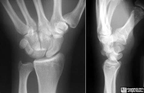 Learningradiology Com Perilunate Dislocation Medical Radiology Xray Tech