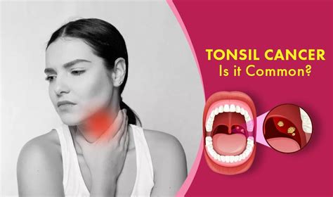 What Is Tonsil Cancer Posteezy