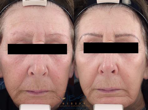 Photorejuvenation Ipl Before And After Photo Gallery Vancouver Bc
