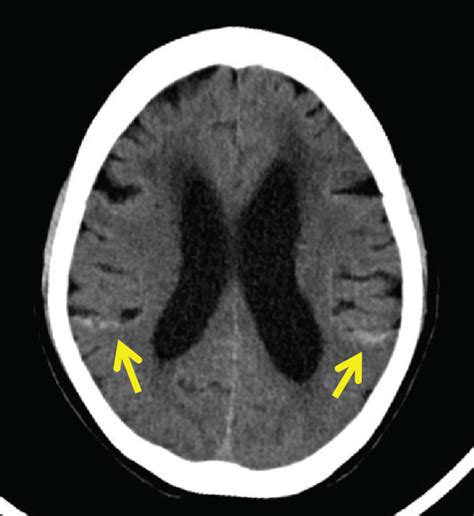 Axial Noncontrast Brain Computed Tomography Showing A Subarachnoid