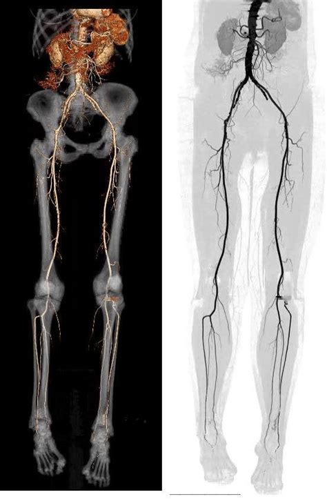 Ct Angiography With Lower Extremity Runoff Volume Render And Inverted