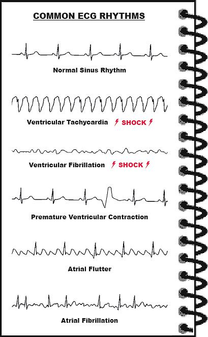 Best Way To Learn Ekg Rhythms Just For Guide