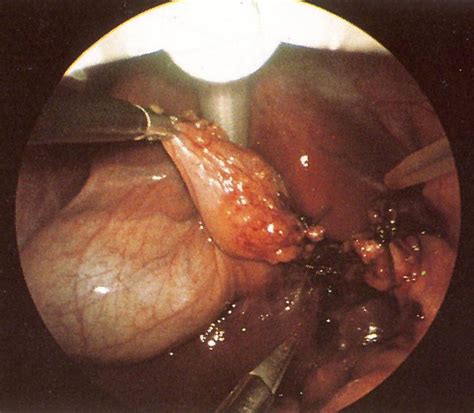 Wann und warum sollte die gallenblase raus? MVZ Chirurgie Kiel am Ostufer - Gallenblasenentzündung und ...