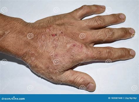 Tinea Manus Or Fungal Infection On Hand Of Southeast Asian Burmese