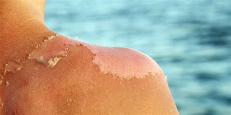 What To Do When Your Sunburn Starts Peeling