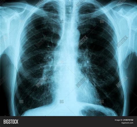 Healthy Chest Mri X Image And Photo Free Trial Bigstock