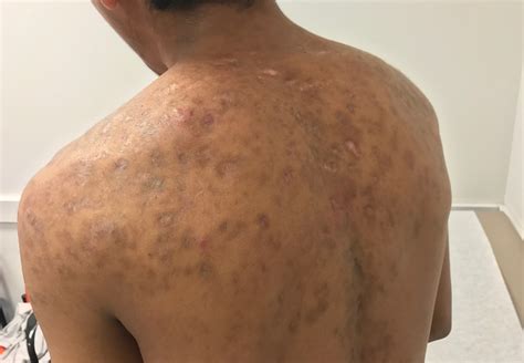 Severe Acne On The Face And Chest Clinical Advisor