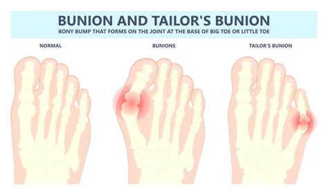 Tailors Bunion How To Treat A Tailors Bunion Pinky Toe Bunion