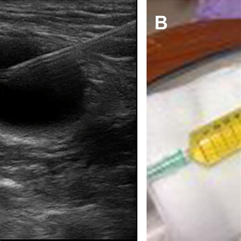 A Aspiration Of The Fluid Within The Cyst Under Ultrasound Guidance