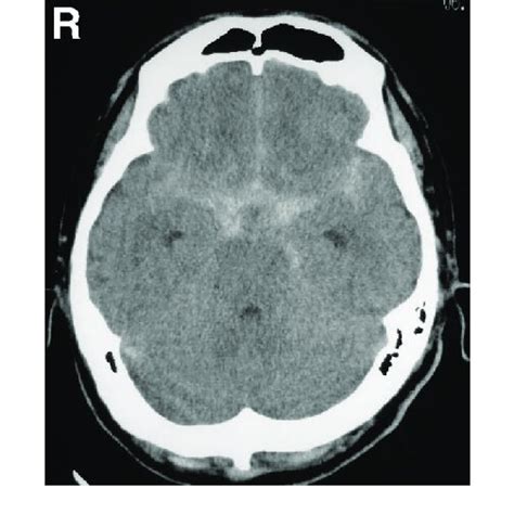 Brain Computed Tomography Scan On Admission Showing Subarachnoid