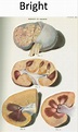 Richard Bright's depiction of the kidneys in dropsy, 1827 (6 ...