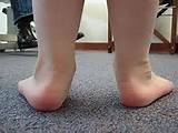 Pictures of Pain From Flat Feet