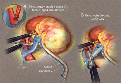 Renal Vessels Transection In Laparoscopic Live Donor Nephrectomy I
