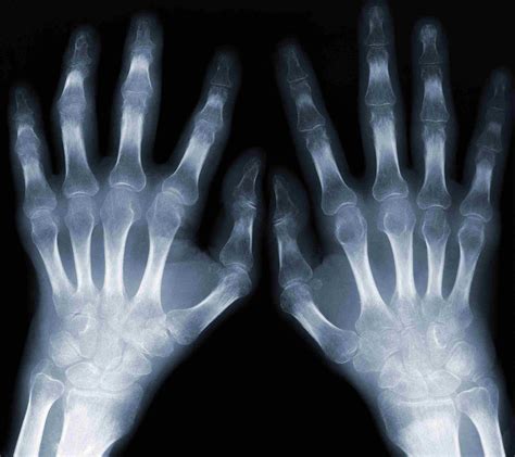 List 90 Wallpaper Normal X Ray Of Hand And Wrist Excellent