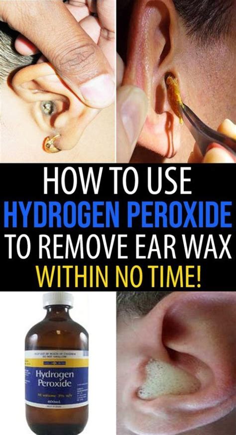 Cleaning Ears With Hydrogen Peroxide Zonejord