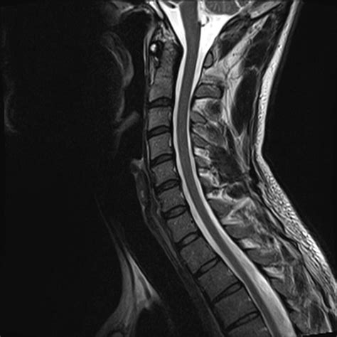 Normal Cervical Spine Mri Image