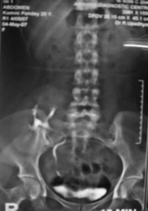 X Ray Abdomen With An Intravenous Pyelogram Shows Ectopic Kidney Lying