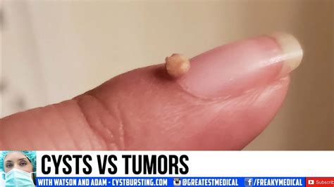 Cysts Vs Tumors What S The Difference Watson YouTube