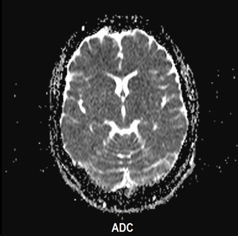 Diffusion Weighteddwi Brain Mri Axial Image