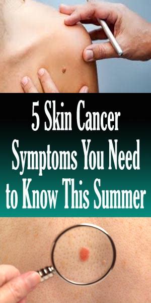 5 Skin Cancer Symptoms You Need To Know This Summer Nutrition Health