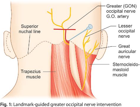 Figure 1 From Ultrasound Guided Greater Occipital Nerve Intervention A