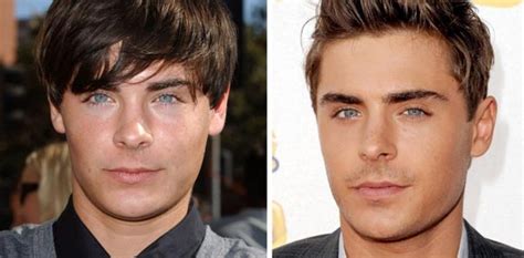 Zac Efron Nose Job Plastic Surgery Before And After Photos
