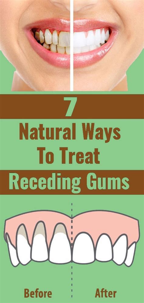 7 Natural Ways To Treat Receding Gums In 2020 Receding Gums Foods
