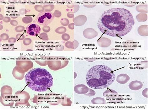 Haematology In A Nutshell Toxic Granulated Neutrophils