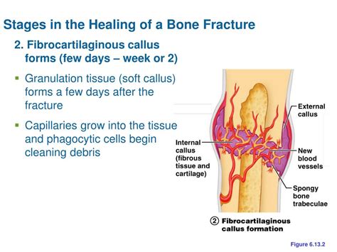 Ppt Bone Fractures Breaks Powerpoint Presentation Id2694136