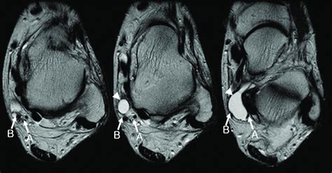 Tarsal Tunnel Syndrome Caused By Ganglion Cyst Axial T2 Weighted Image