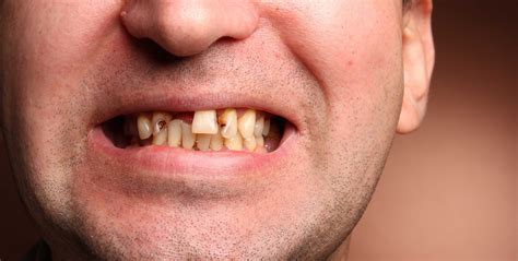 One In Five Brits Visit The Dentist Only When Theres A Problem With