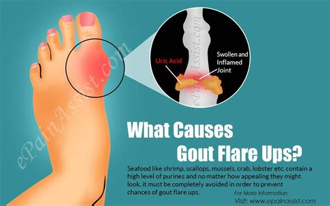 What Causes Gout Flare Ups And How To Get Rid Of It Gout Flare Up