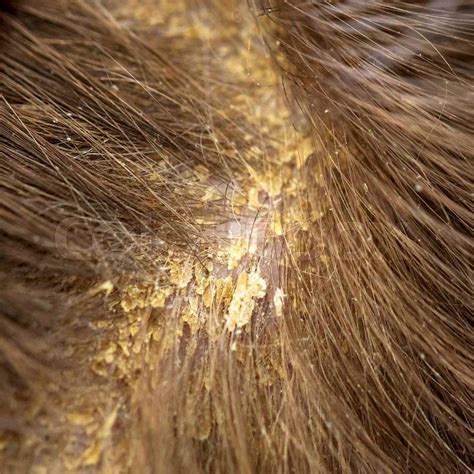 Dandruff In The Hair Flaky Scalp Seborrhea Macro Shot Childrens